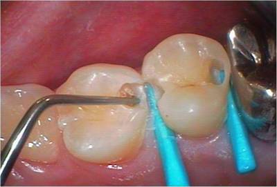 caries3.jpg