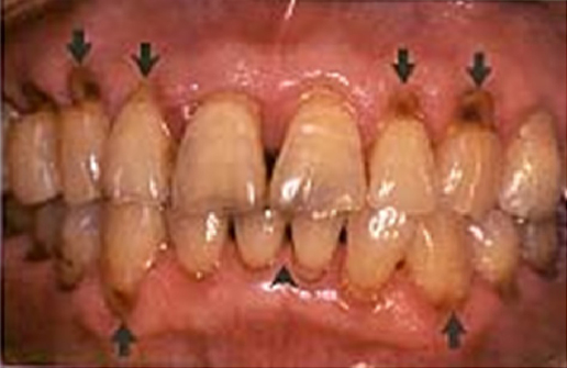 一例として唾液分泌が悪くなり独特の歯頚部う蝕が多発