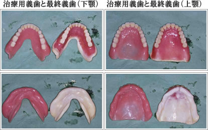 義歯