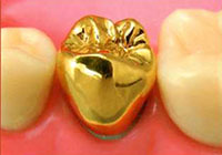 ゴールド・臼歯